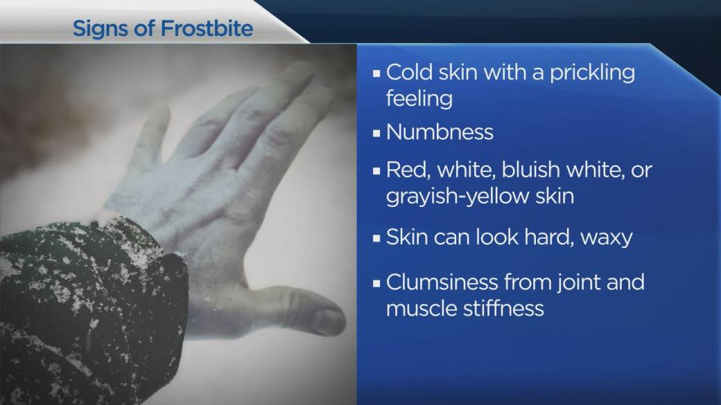 Click to play video: 'Recognizing the signs of frostbite and hypothermia'